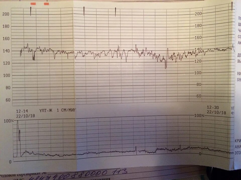 Шевеления на 35 неделе. Результаты КТГ. Шевеления на КТГ. Шевеления плода на КТГ. КТГ расшифровка.
