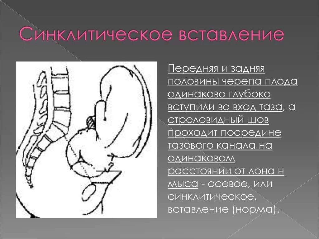 Малый сегмент плода. Асинклитические вставления плода. передний и задний асинклитизм. синклитическое вставление головки. виды асинклитического вставления головки плода.
