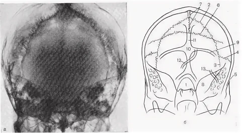 Швы черепа анатомия рентген. Рентгенография черепа (краниография. Снимок черепа в боковой проекции норма. Задняя проекция черепа. Задняя проекция черепа.