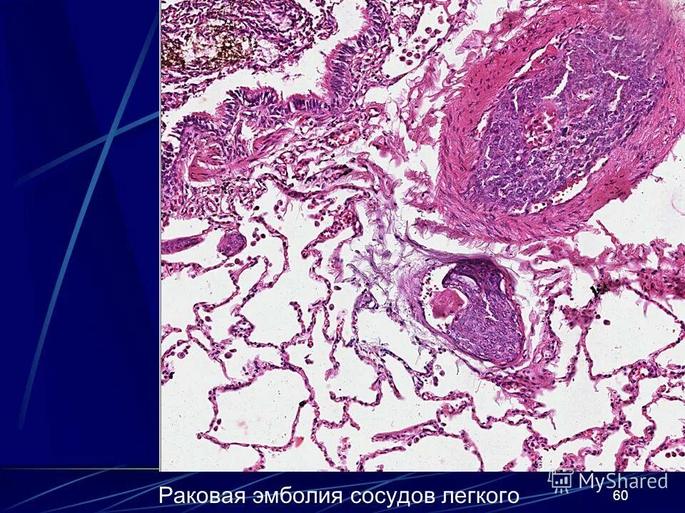 Тромб артерии микропрепарат. Эмболия патологическая анатомия. Опухолевые эмболы в сосудах. Тромб микропрепарат