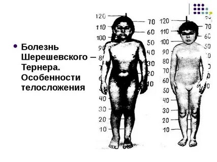 Симптомы шерешевского тернера