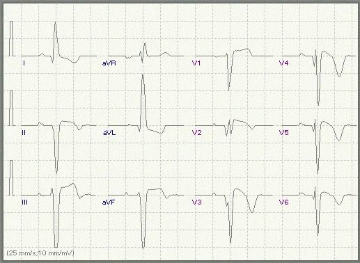 Блокада левой задней ножки. Блокада левой ветви пучка Гиса. Блокада задней ветви ЛНПГ. Блокада задней ветви левой ножки на ЭКГ. Блокада левой задней ветви пучка Гиса на ЭКГ.