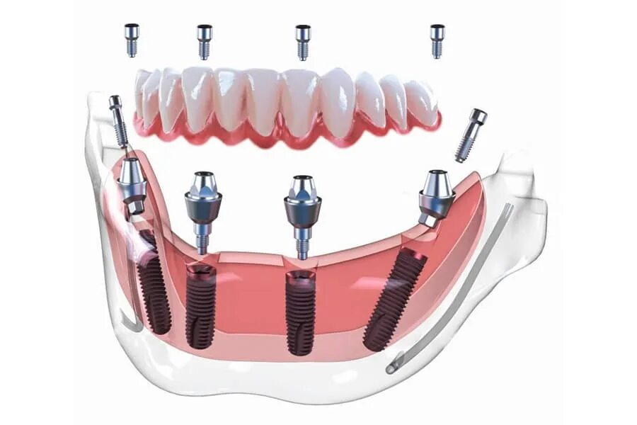 Имплант зуба Osstem. Протезы на имплантатах по технологии all-one-4 all-one-6. Имплантация sup aznona com