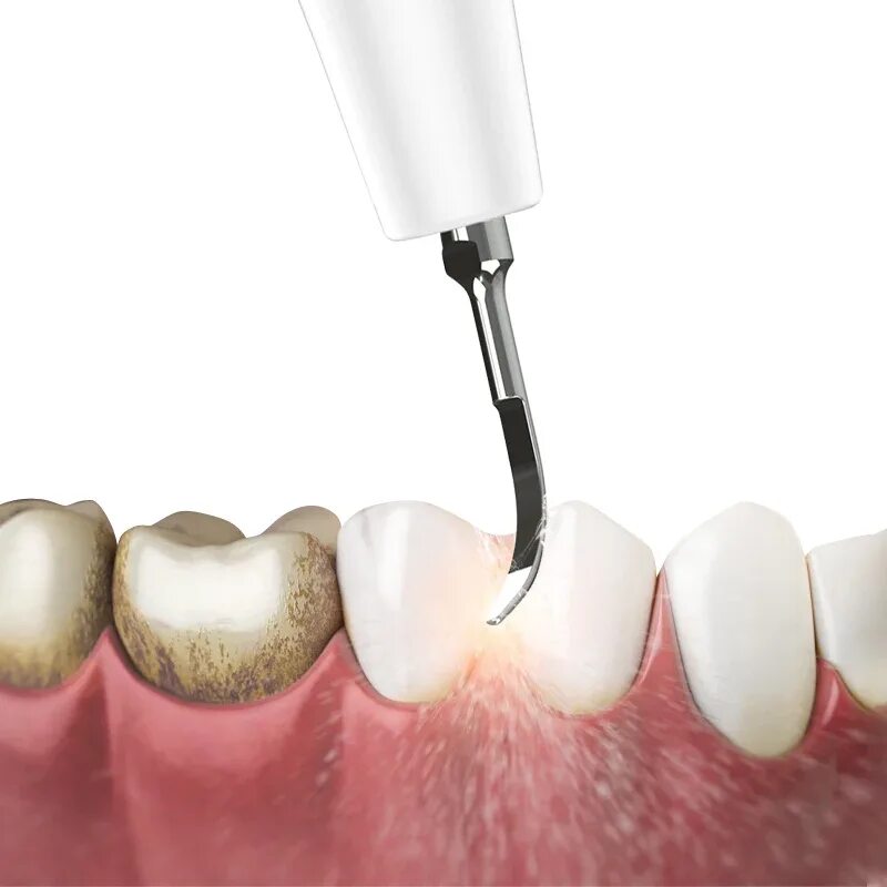 Как называется инструмент для чистки зубов ультразвуком. Чистка зубов ультразвуком. Ультразвуковая чистка зубов скалером.