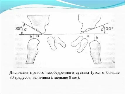 Углы суставов ребенка норма