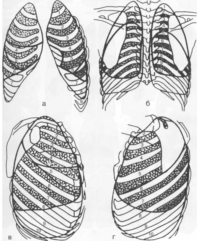 Топографическая анатомия легких доли сегменты. Доли легкого анатомия топография. Топография ребер грудной клетки. Проекция долей легких на грудную клетку. Границы легкого по ребрам