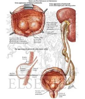 Әйелдердегі уретроцеле (порно фото)