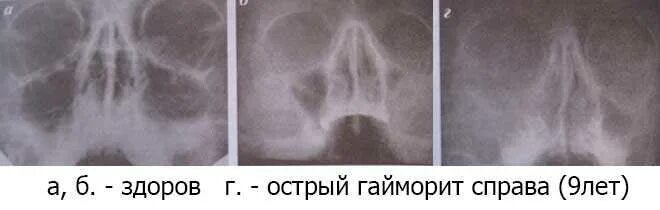 Может ли гайморит перейти в менингит. Пристеночный гайморит рентген. травматический гайморит (верхнечелюстной синусит). острый левосторонний одонтогенный гайморит. гиперпластический гайморит рентген.