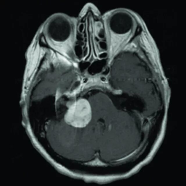 Шваннома слухового нерва кт. Невринома слухового нерва опухоль. Невринома слухового нерва мрт. Акустическая невринома опухоль слухового нерва. Нейрома