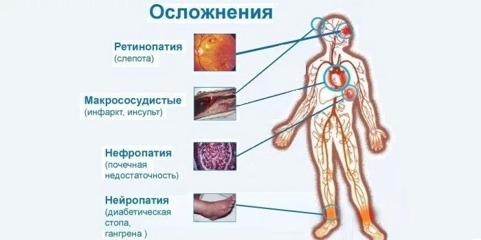 Осложнения при гипогликемической коме. Осложнения гипергликемической комы. Гипогликемическая кома симптомы осложнения. Осложнения при гипогликемической коме у детей. Осложнения раз