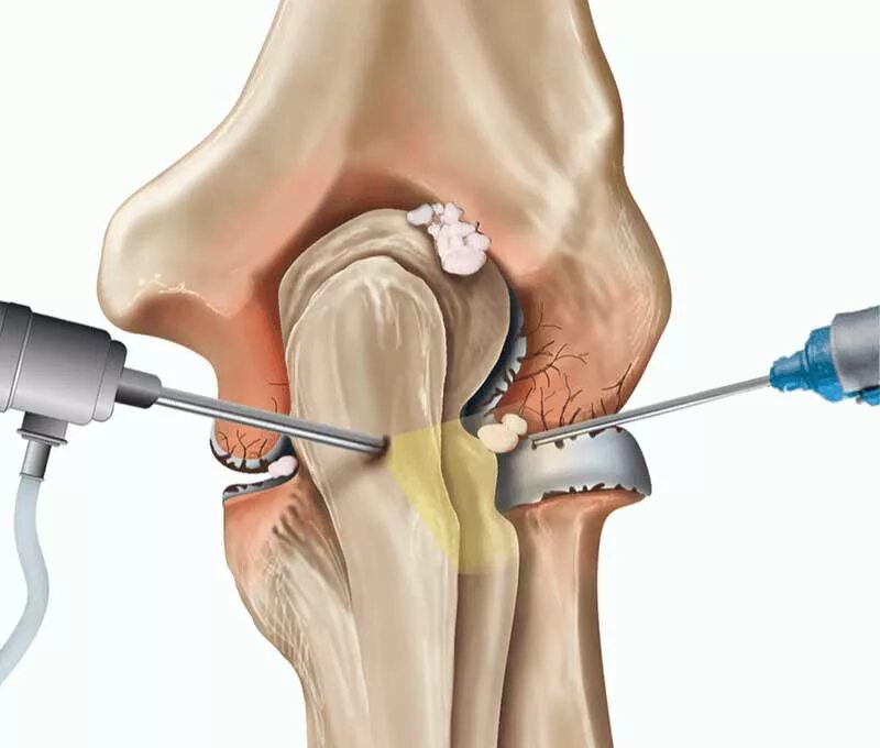Болезнь Кенига артроскопия. Артроскопическая резекция мениска. Мениск коленного сустава операция. Болезнь Кенига коленного сустава операция.