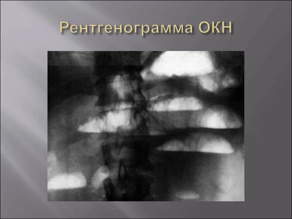 Формы кишечной непроходимости