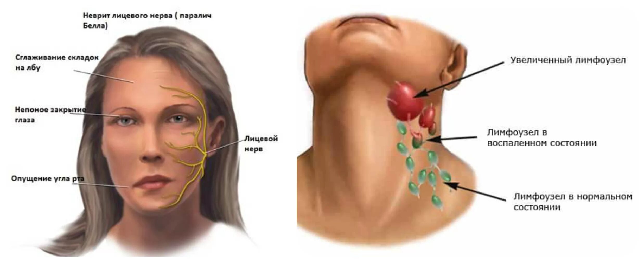 Причины увеличения лимфатических узлов. Воспаление лимфа лицевого лимфатического узла. Неврит лицевого нерва лимфоузлы.