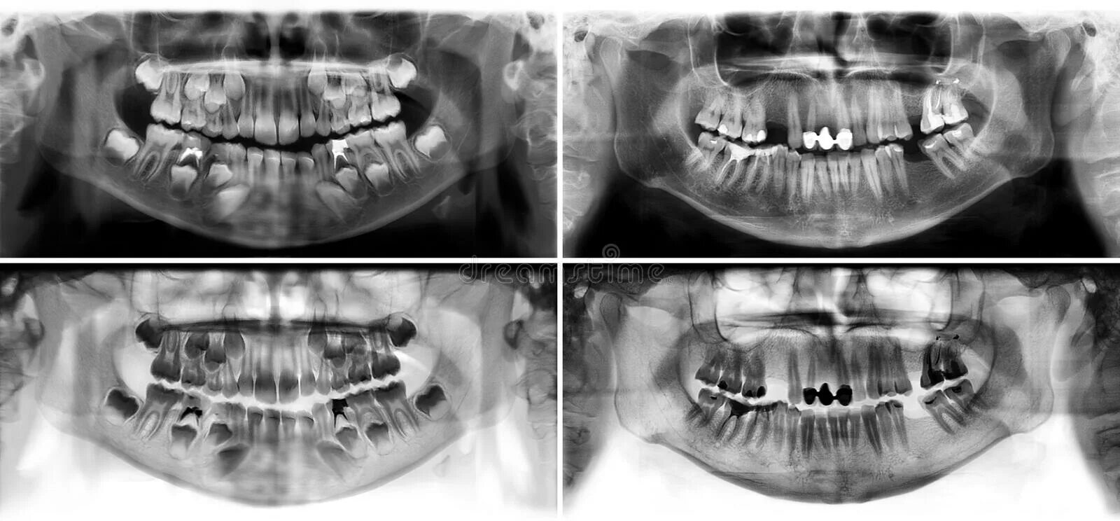 Рентгенография верхней и нижней челюсти панорамная. Панорамная рентгенография верхней челюсти. Панорамный снимок зубов ребенка 7 лет. Молочные зубы снимок ОПТГ.