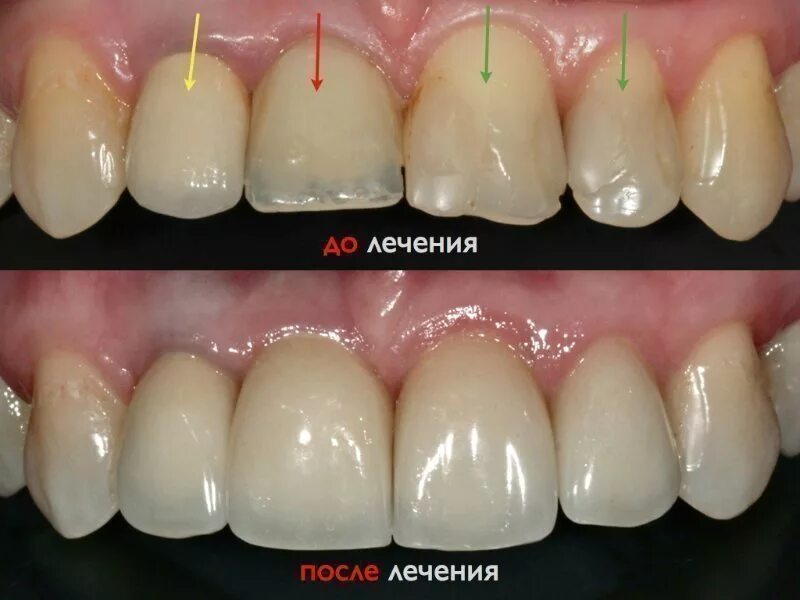 Пришеечный прикорневой кариес. Пришеечный кариес клыка. Гипоплазия флюороз кариес. Айкон пришеечный кариес.