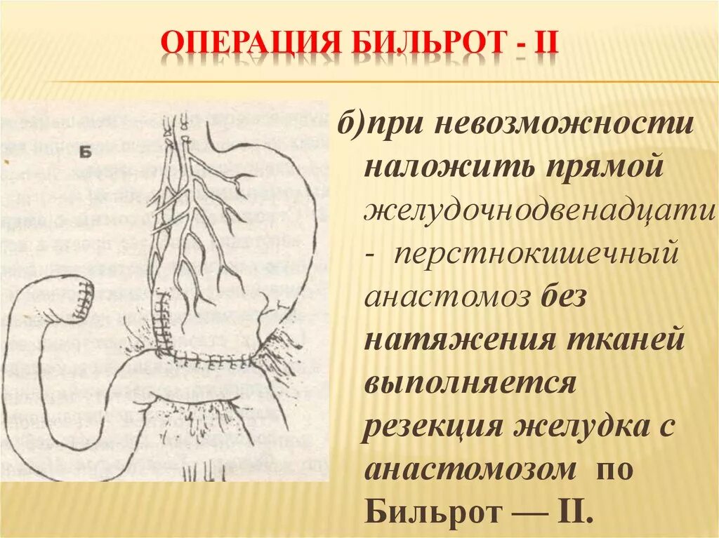 Операция по Бильрот 1 и 2. Операция Бильрот 1 анастомоз. Анастомозит что это