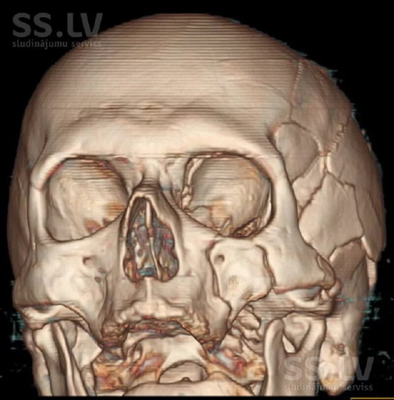 Трещина в голове. Компьютерная томограмма черепа. Компьютерная томография костей черепа.