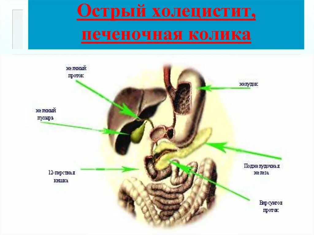 Печеночная колика. Печеночная колика острый холецистит. Печеночная колика холецистит.