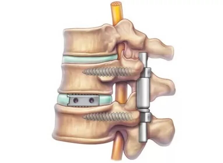 Оперативное лечение позвоночника. Передний спондилодез Кейджем с5-с6. Дискэктомия с5-с6 корпородез Кейджем. Передний спондилодез поясничного отдела позвоночника операция. Спондилодез поясничного отдела позвоночника Кейджем.
