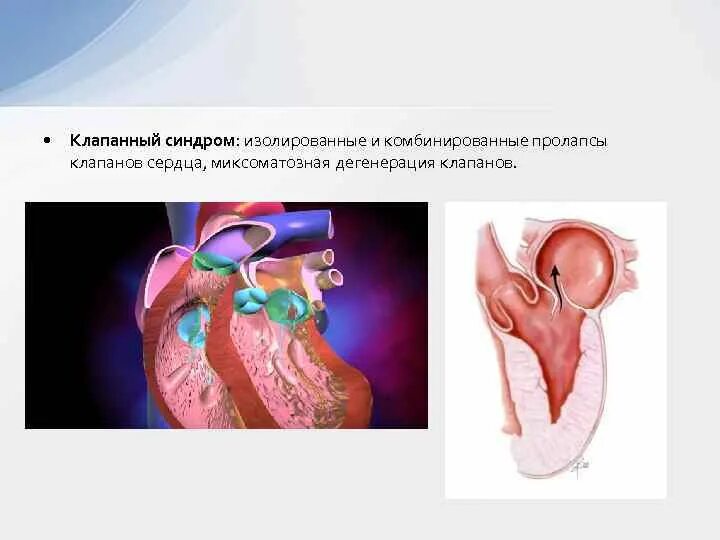 Миксоматозная дегенерация. Миксоматозная дегенерация митрального клапана ЭХОКГ. Миксоматозная дегенерация митрального клапана синдром. Миксоматозная дегенерация аортального клапана. Миксоматозная дегенерация клапана.