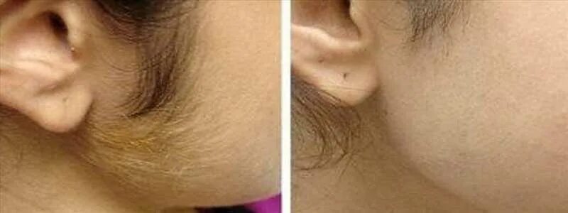 Лечение волос лазером до и после Effects Of Laser Treatment For Hair Removal Hotsell
