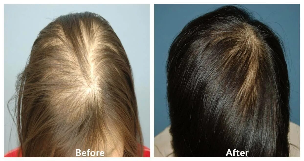 Сильные волосы отзывы. Плазмолифтинг алопеция. Плазмолифтинг для волос алопеция. Мезотерапия для волос. Мезотерапия волос до и после.