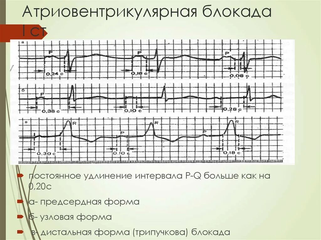 Атриовентрикулярная блокада признаки. ЭКГ АВ блокада 1. Атриовентрикулярная блокада на ЭКГ. АВ блокада на ЭКГ. Атриовентрикулярные блокады на ЭКГ.