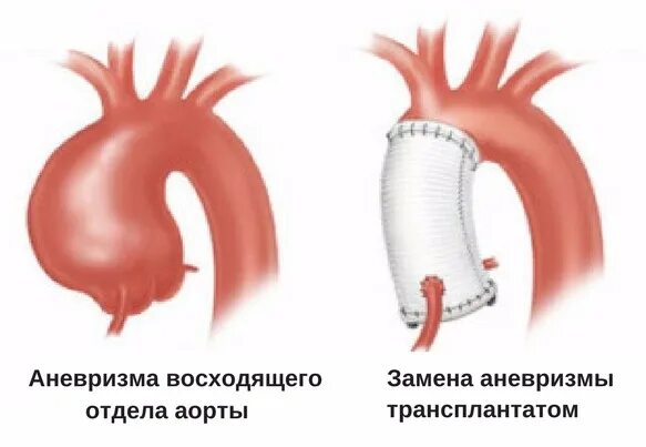 Аорта расширение восходящего отдела аорты. Операции при аневризме восходящего отдела аорты. Хирургия аневризма восходящего отдела аорты. Расширение аорты операция. Аневризма восходящей аорты операция