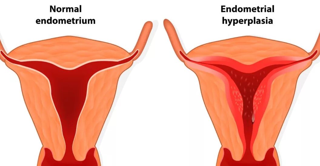 Гиперплазия эндометрия. Эндометрий при месячных. Воспаление слизистой оболочки матки