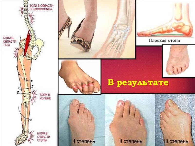 Стоп стали. Скелет стопы плоскостопие. При плоскостопии болят стопы. Плоскостопие от каблуков.