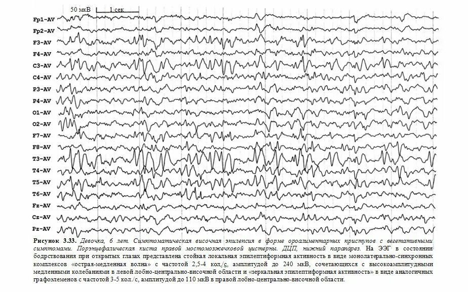 Низкоамплитудная ээг. Низкоамплитудный Тип ЭЭГ. Эпилептиформная активность на ЭЭГ. Роландическая эпилепсия ЭЭГ. Низкоамплитудная, неустойчивая ЭЭГ.