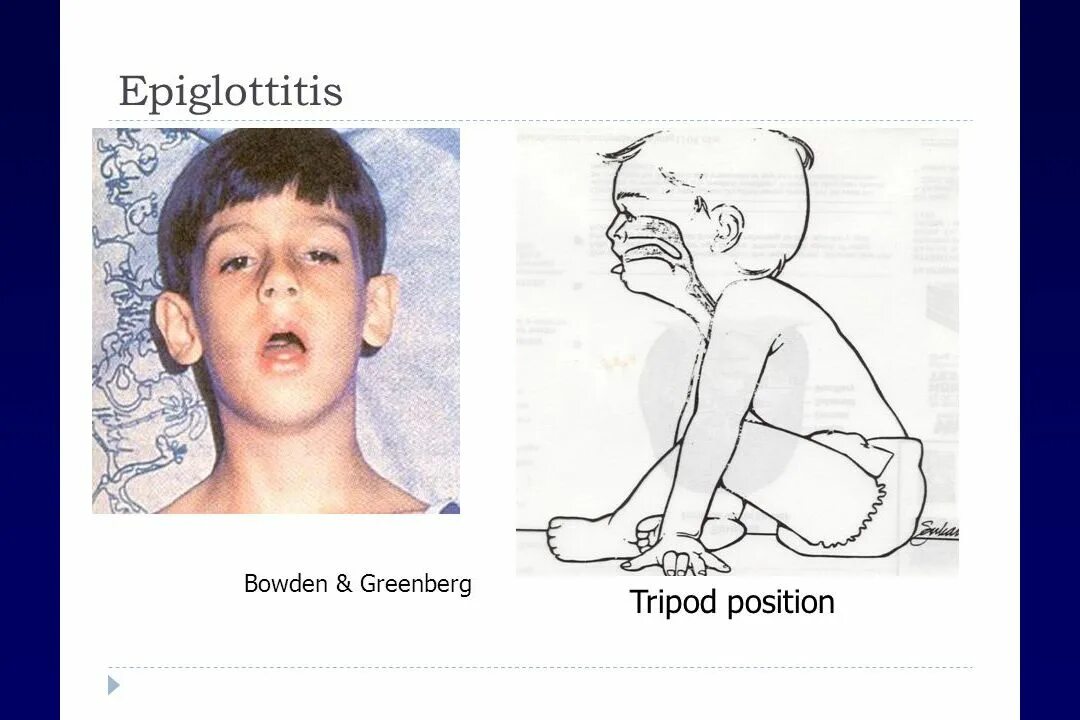 Эпиглоттит симптомы. Симптомы эпиглоттита у детей. Острый эпиглоттит у детей. Эпиглоттит клинические формы.