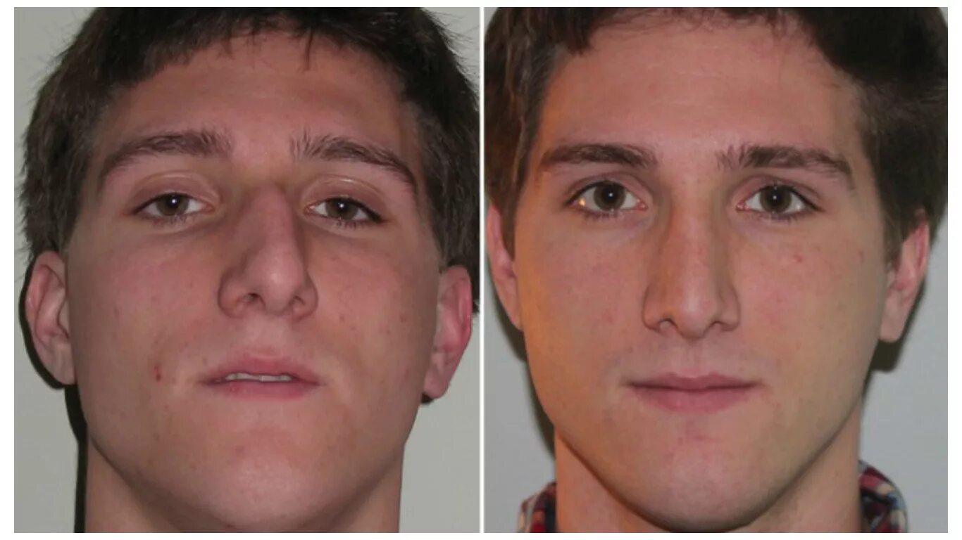 Бродовский максим борисович септопластика. Исправление перегородки. Перелом носа исправление. Перелом носа исправление. Исправление сломанного носа.