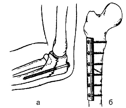 Перелом лодыжки с остеосинтезом. Шурупы при переломе. Накостный остеосинтез н/3 лучевой кости. Операция остеосинтез большеберцовой кости пластиной. Остеосинтез плечевой кости пластиной.