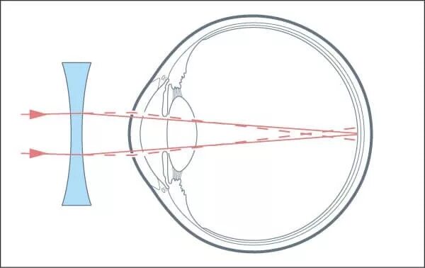 Как можно скорректировать зрение при помощи линз. Линзы для коррекции миопии. Линзы для близорукости и дальнозоркости физика. Линзы для коррекции миопии (близорукости). Линзы для глаз для зрения миопия.