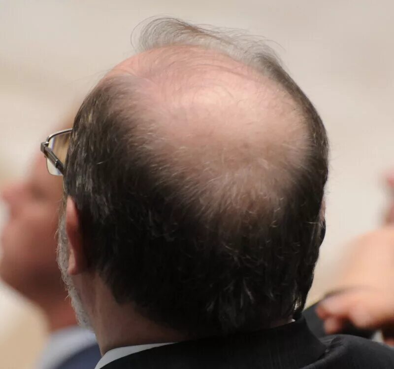 Лысая голова. Мужчины прикрывающие лысину. Лысые головы мужчин. Лысая мужская голова. Парик для мужчин на лысину.