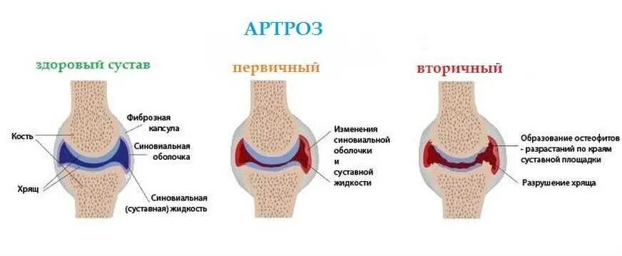 Артроз суставов признаки. Первичный деформирующий остеоартроз. деформирующий артроз памятка. первичный деформирующий артроз.