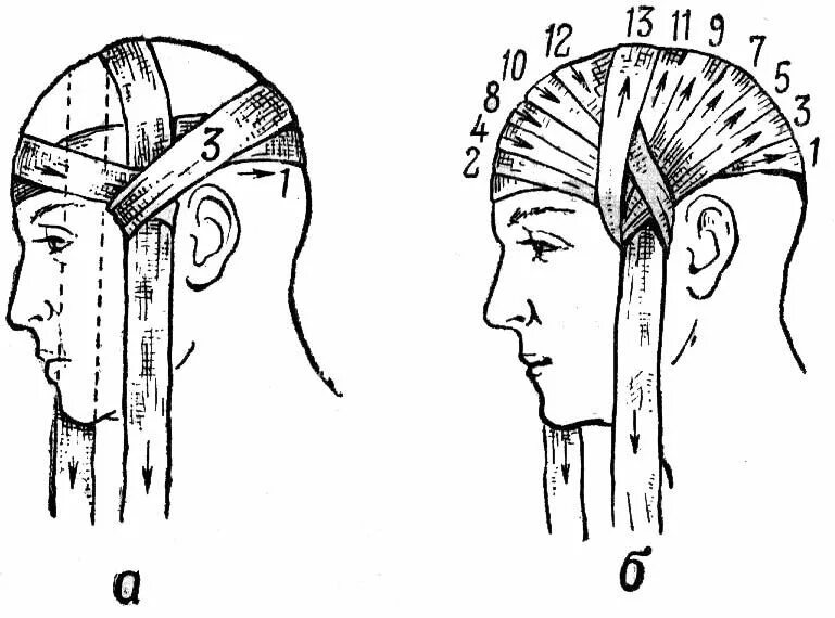 Бинтование головы чепец. Наложение повязки на голову чепец. Повязка чепец техника. Перевязка головы чепец.