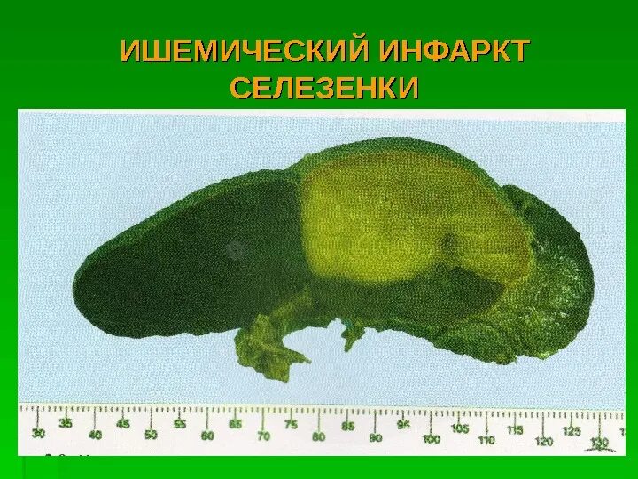 Инфаркт почки цвет мочи. Ишемический инфаркт селезенки. Анемический инфаркт селезенки. Некроз селезенки макропрепарат. Инфаркт селезенки микропрепарат.