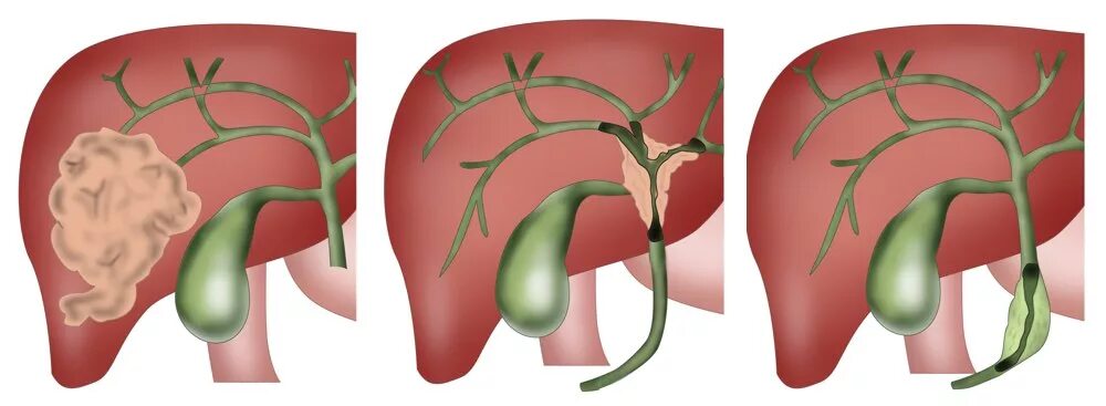 Желчный пузырь мясников. Опухоли внепеченочных желчных протоков. Внутрипеченочный желчный проток. Холангиокарцинома желчных протоков. Холангиокарцинома желчного пузыря.
