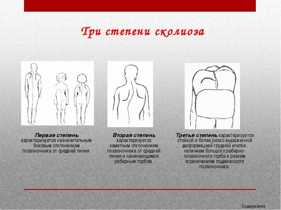 Искривление позвоночника лордоз. Профилактика осанки. Три степени нарушения осанки. Степени нарушения осанки биология. Осанка лордоз кифоз сколиоз.