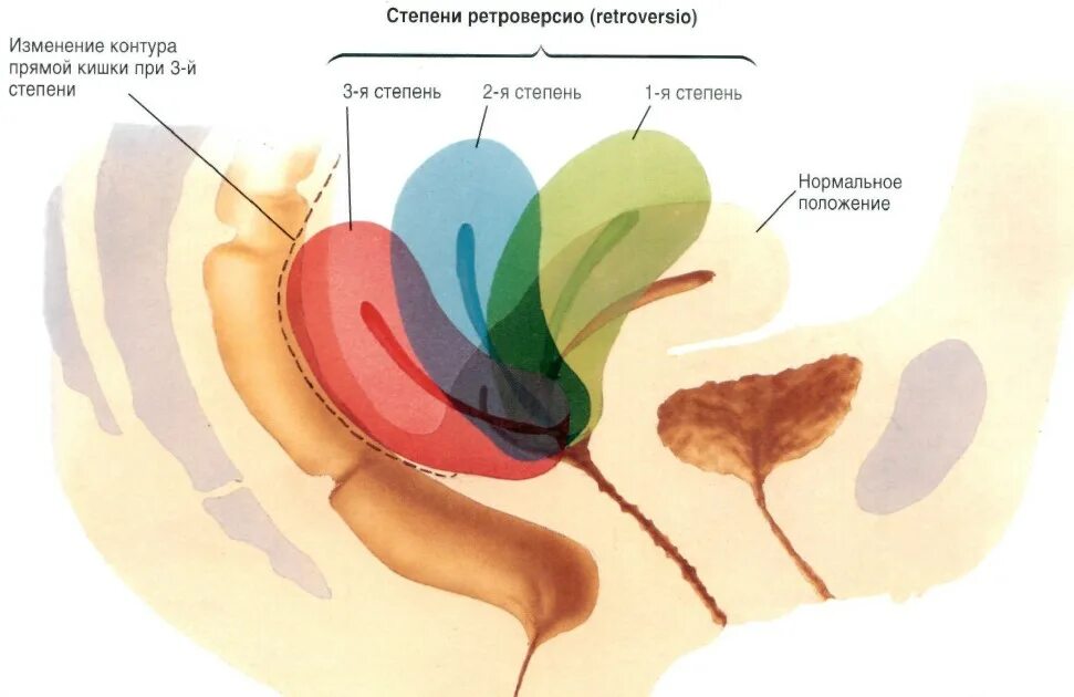 Без видимых изменений. Расположение шейки матки кзади. Матка retroflexio retroversio. Расположение матки ретрофлексия. Физиологическое положение матки.