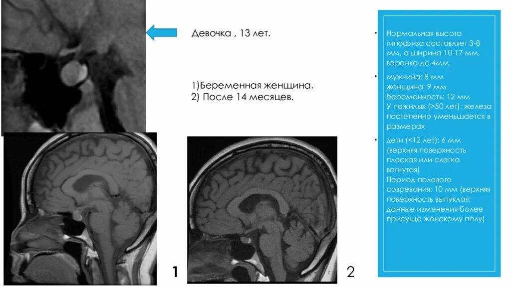 Изменения гипофизе. Опухоль аденома гипофиза. Микроаденома мрт т2. Микроаденома гипофиза атипичная. Аденома гипофиза заключение мрт.