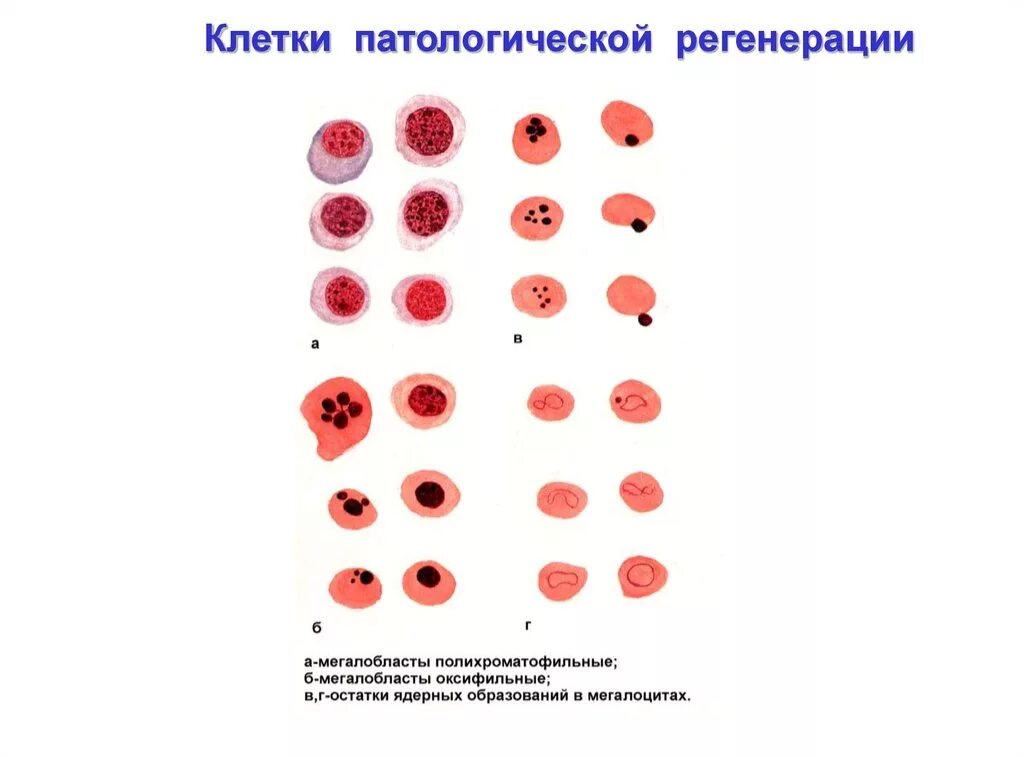 Патологическая регенерация патанатомия. Клетки патологической регенерации. Виды патологической регенерации. Полихроматофильные эритроциты. Патологические клетки крови не обнаружены