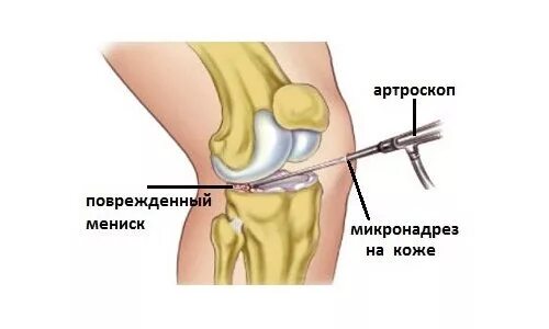 Удаление сустава. Операция на разрыв мениска артроскопия. операции при поврежденном мениске коленного сустава. разрыв мениска коленного сустава после операции. артроскопия коленного сустава разрыв мениска.