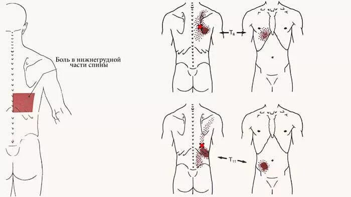 Триггерные точки поясницы. Подвздошно реберная мышца триггерные точки. Триггерныетрчки подвздошнореберная. Триггерные точки внизу живота. Подвздошно реберная мышца спины триггерные точки.