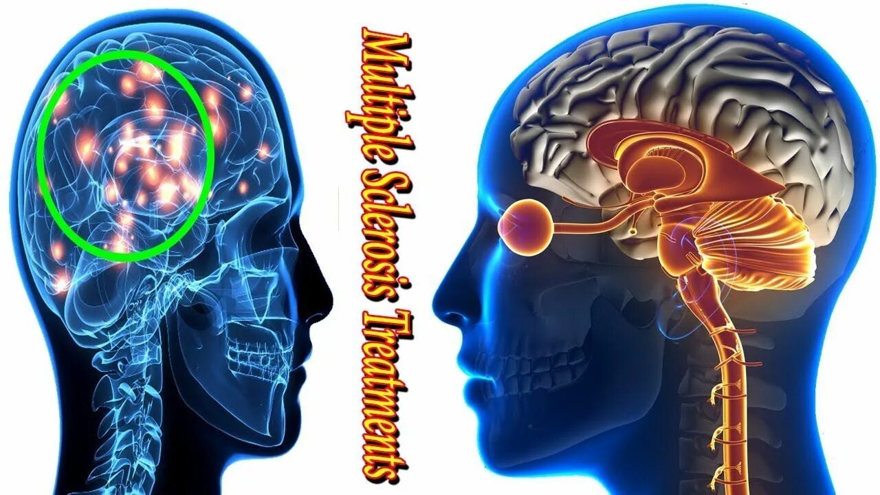 Склероз мозга. Нервная система женщины. Multiple Sclerosis MS. Нервная система человека мозг и нервы. Склероз арт.