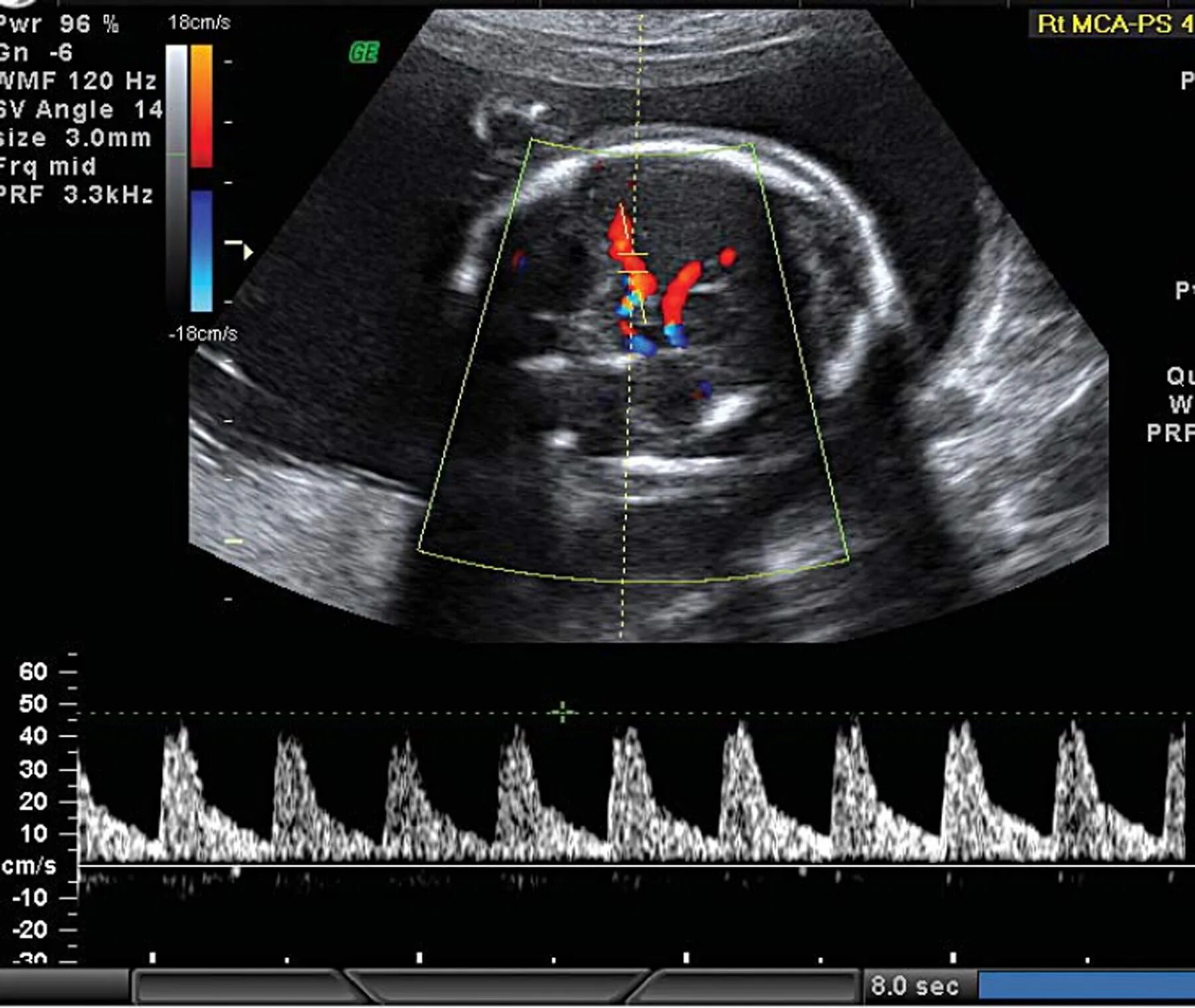 Сма плода. Допплерометрия средней мозговой артерии плода. Средняя мозговая артерия плода допплер. Допплер СМА плода. Средняя мозговая артерия на УЗИ.