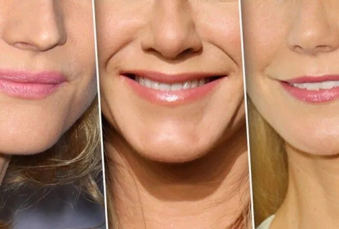 Изменение губ с возрастом. Дженис дикинсон после пластические операции. Губы становятся тоньше. Меган фокс ринопластика. Губы становятся тоньше.