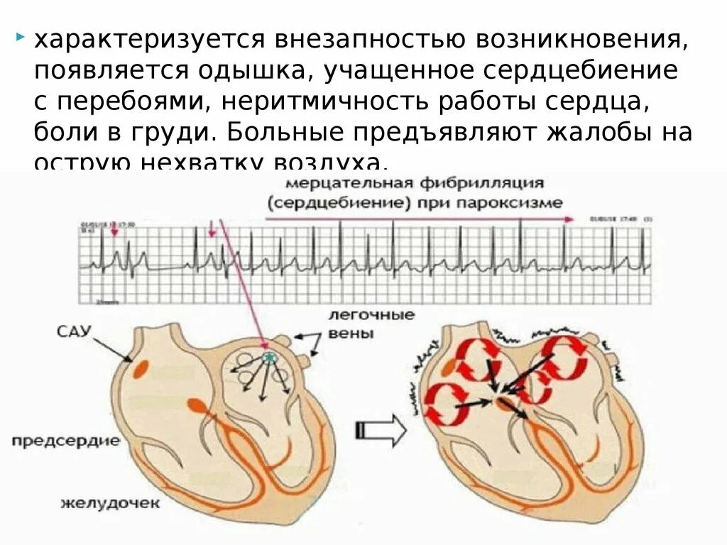 Сердце учащенное сердцебиение. Пароксизмальная форма фибрилляции предсердий. Пароксизмальная аритмия. Одышка и сердцебиение. Фибрилляция предсердий схема.